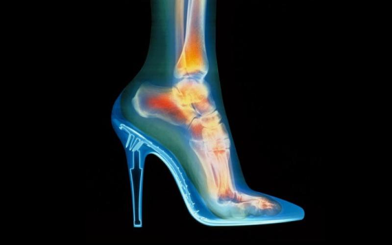 Nombreux accidents de talons en 10 ans