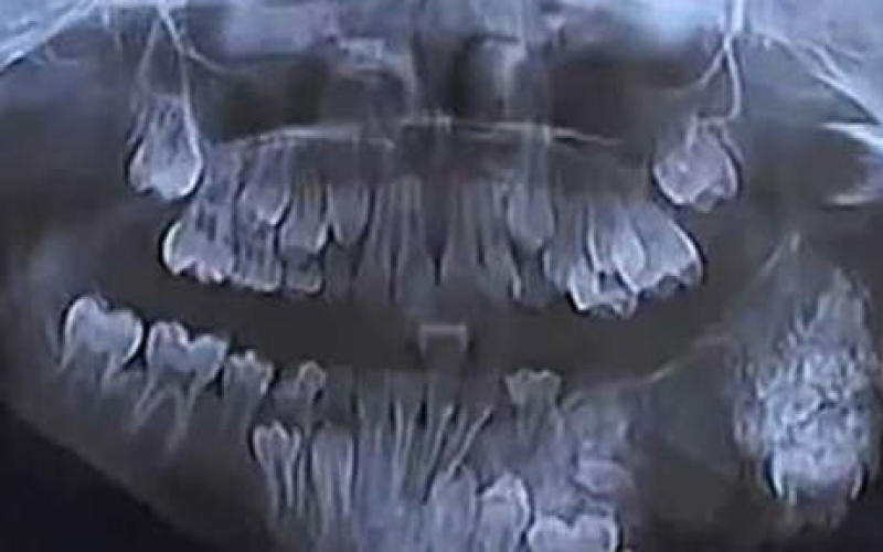 80 dents dans sa machoire