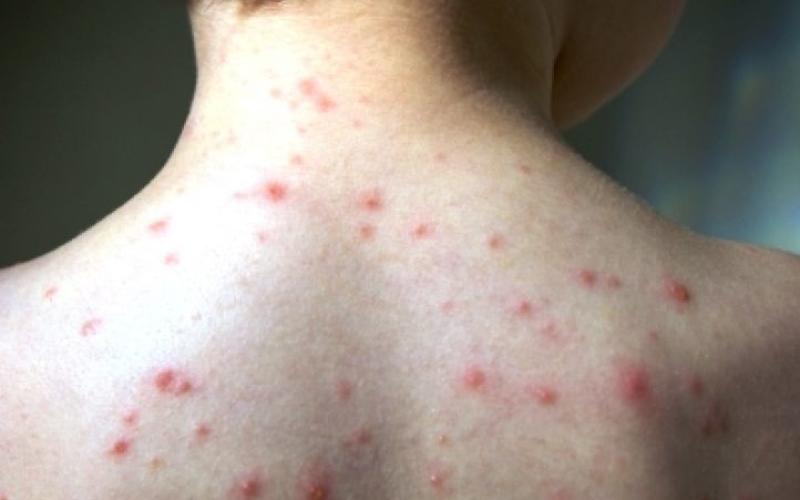 Région : prudence, la varicelle fait son grand retour !